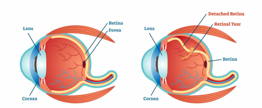descolamento de retina