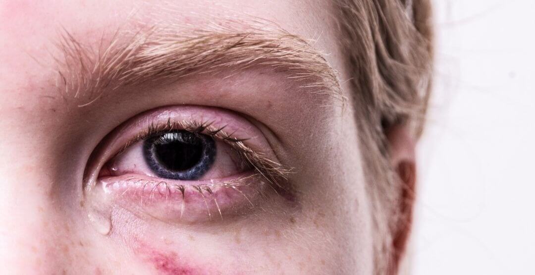 Conheça as novas diretrizes para o tratamento de alergia ocular em crianças e adolescentes