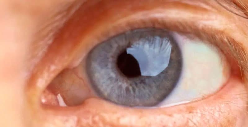 Coronavirus and eyes: Brazilian research finds virus in the retina
