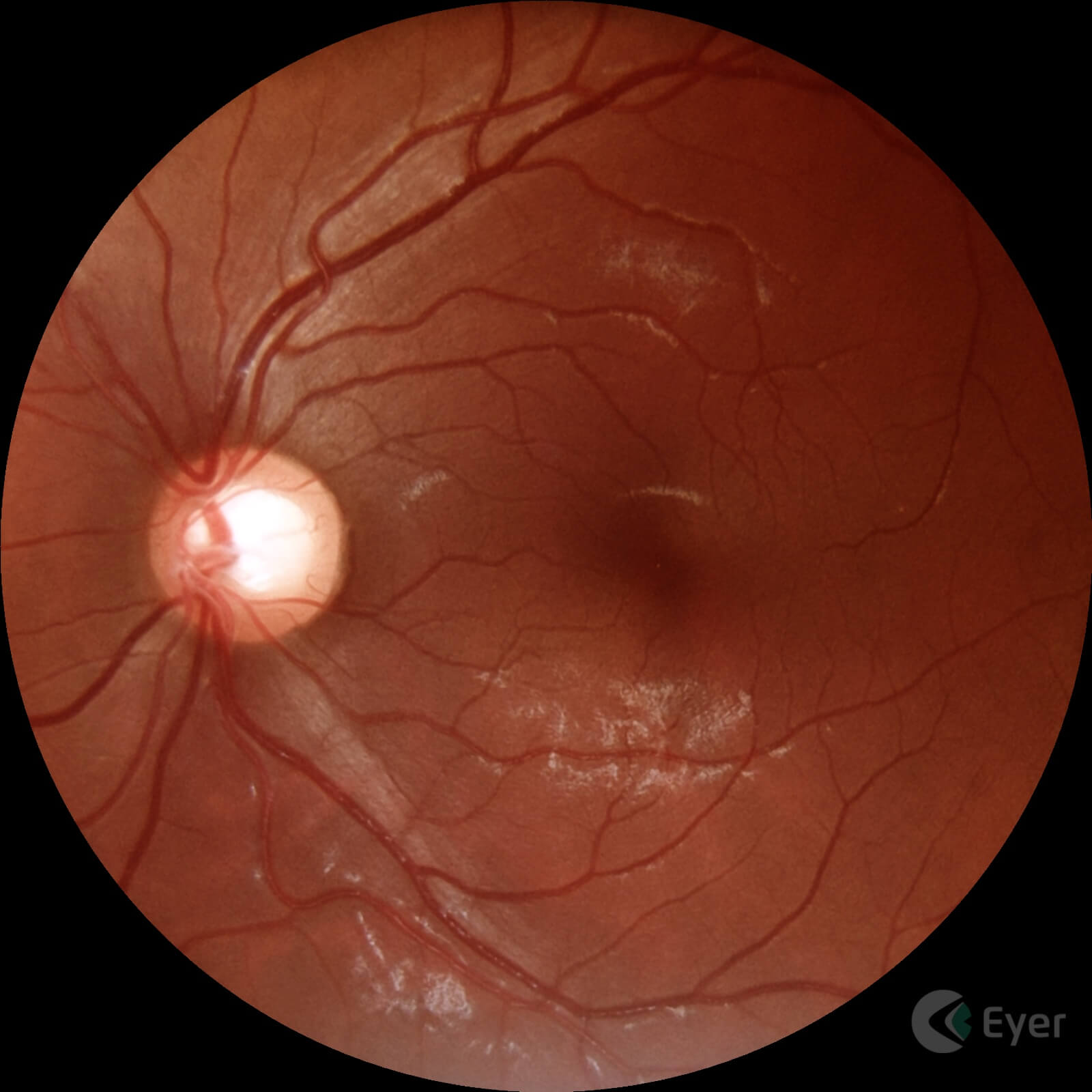 Imagem feito com o Eyer de paciente com glaucoma