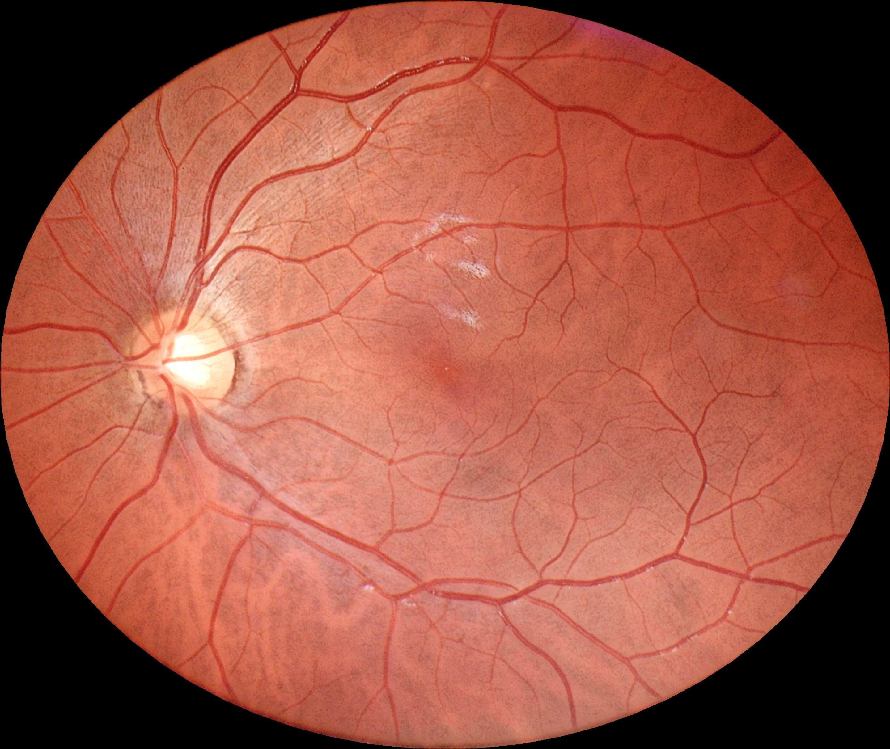 Img Retina Eyer2 Esquerdo