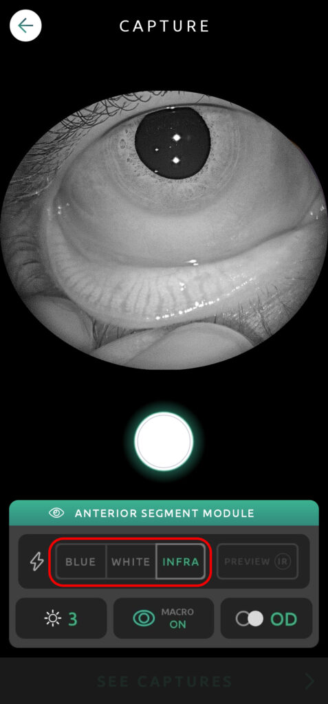 Help Capture Screen Anterior Segment 05