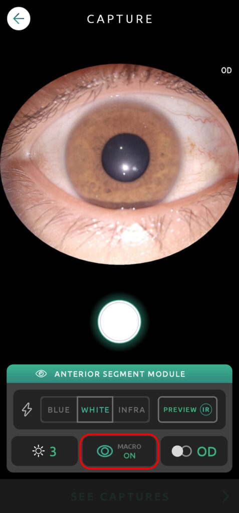 Help Capture Screen Anterior Segment 10