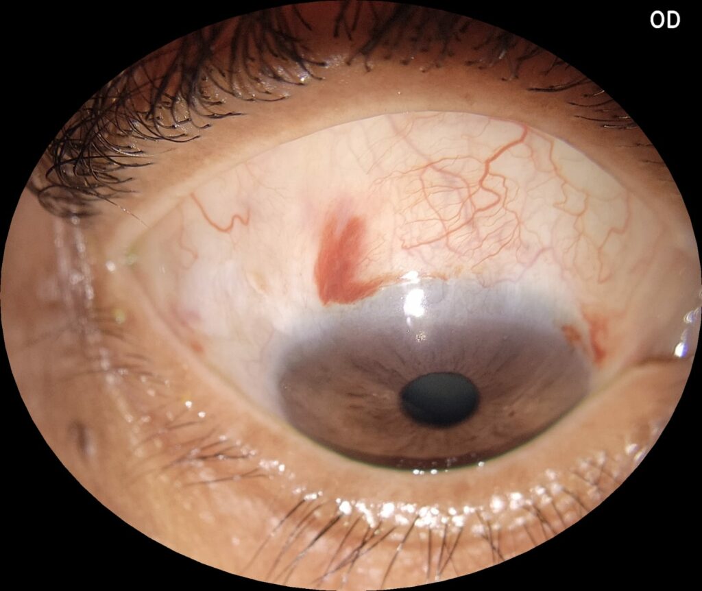 Img Neoplasia Escamosa De Conjuntiva Pos Operatório Eyer2