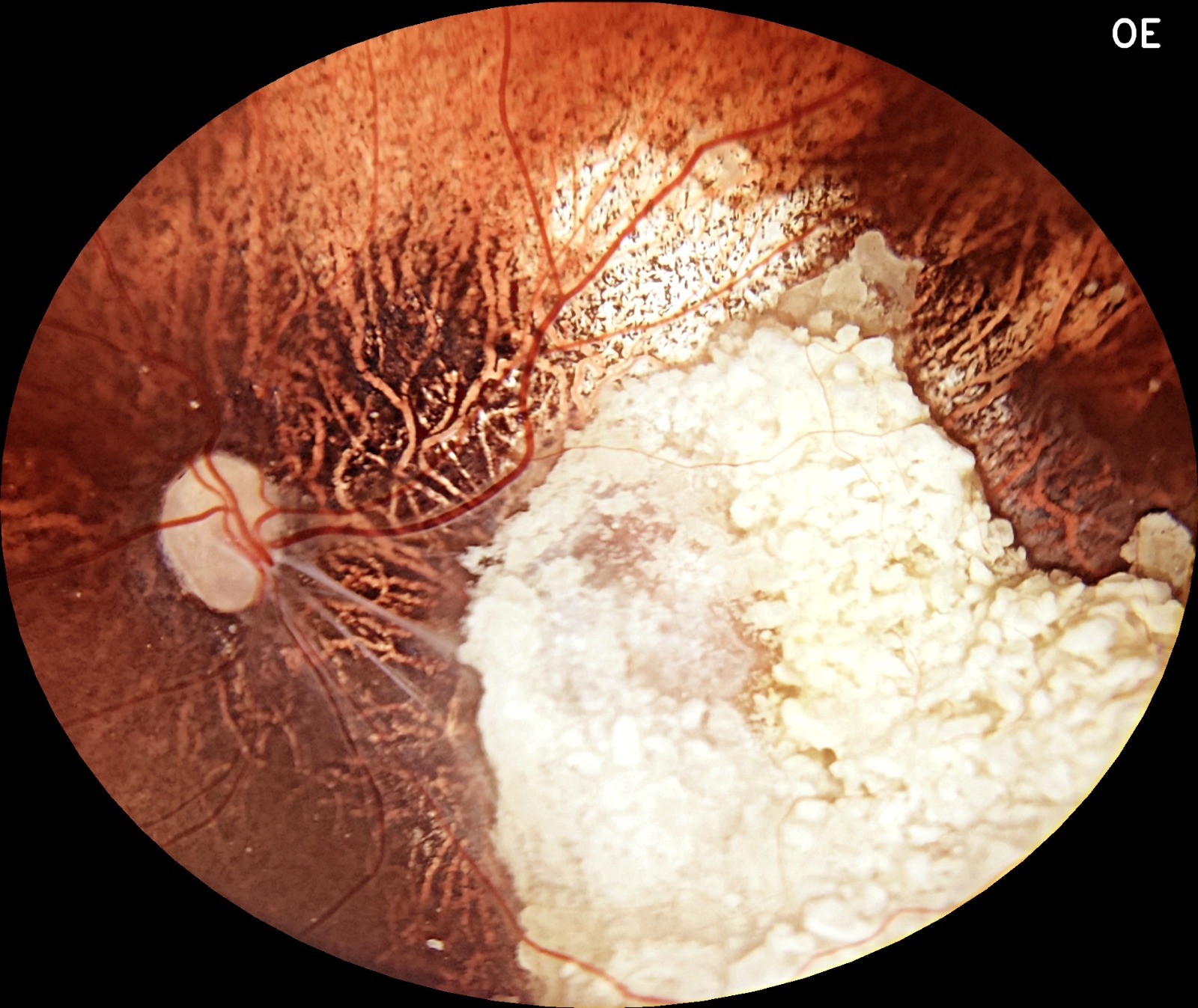 Exame de olhos com retinoblastoma feito com Eyer2.